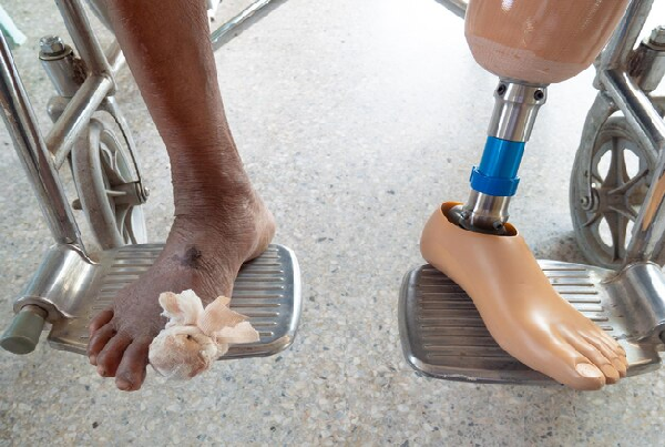 Foot Orthosis