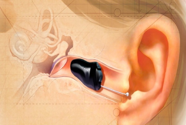 IIC Hearing Aid